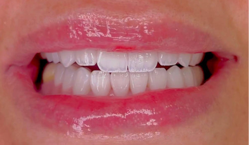 Metal Braces after